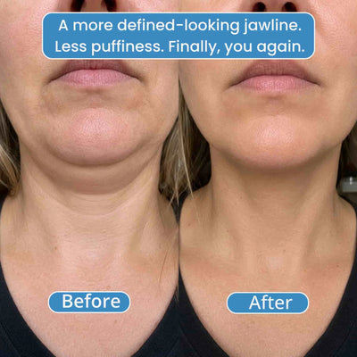 Avea OneSculpt™ face cupping machine