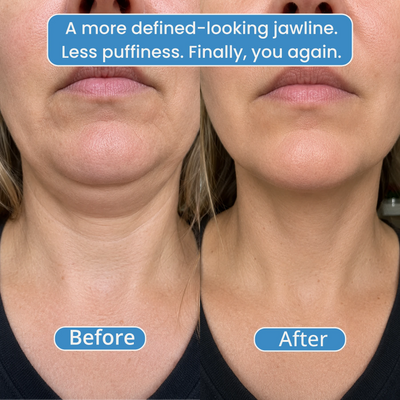 Avea OneSculpt™ face cupping machine