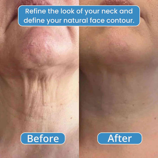 Avea OneSculpt™ face cupping machine